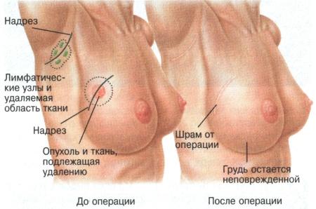 Что такое грудь, молочная железа, рак молочной железы?