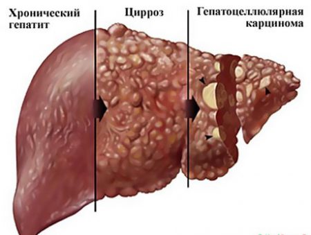 Особенности развития гепатоцеллюлярного рак печени