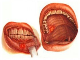 Причины возникновения рака полости рта