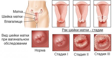 Интимная жизнь и онкология женских органов