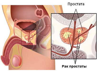 Что такое рак предстательной железы?