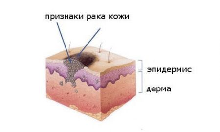 Причины, вызывающие плоскоклеточный рак кожи
