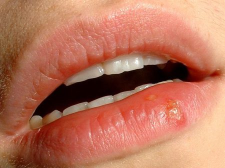Виды заболевания кожного покрова губ