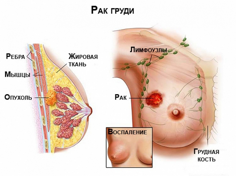 Что подразумевает под собой операция при раке молочной железы и от чего зависит выбор хирургического лечения рака груди?