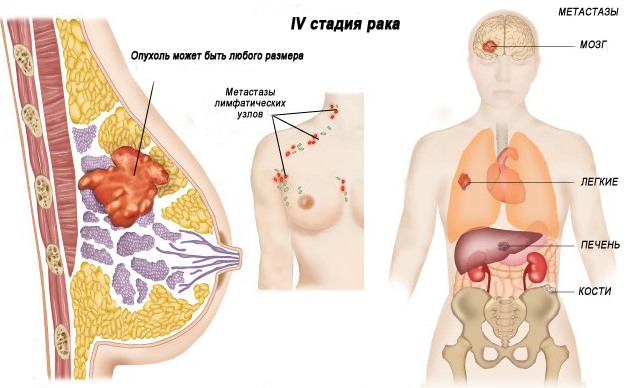 Рак молочной железы - классификация по стадиям