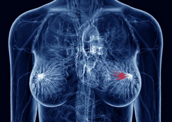 Причины протокового рака молочной железы