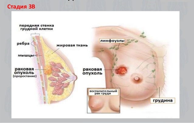 Рак молочной железы - классификация по стадиям