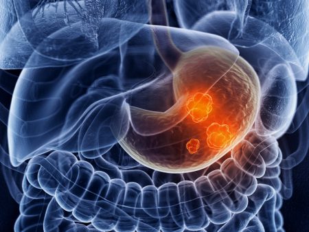Что такое инфильтративный рак желудка?
