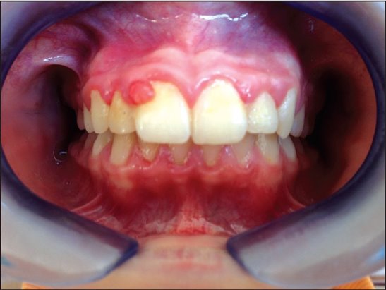 От чего возникает остеогенная саркома челюсти?