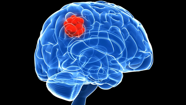 Прогноз пятилетней выживаемости при опухолях головного мозга