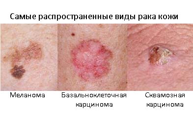 Виды рака кожи