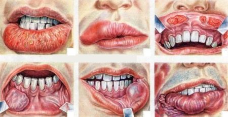Что такое рак губ?