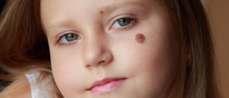 Особенности развития рака кожи у детей: виды опухолей