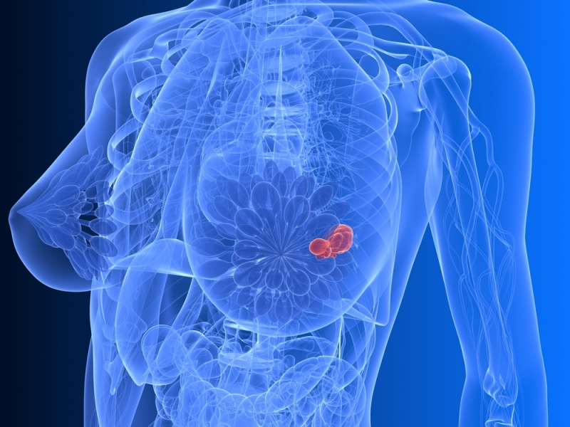 Что такое грудь, молочная железа, рак молочной железы?
