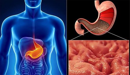 Рак антрального отдела желудка: особенности заболевания