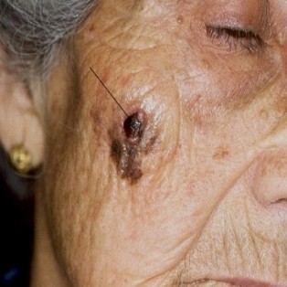 Виды онкологии кожи лица