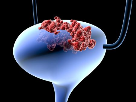 Симптомы высокодифференцированного рака мочевого пузыря