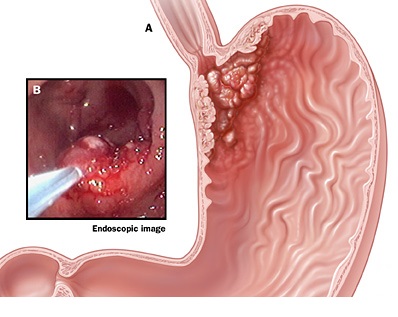 Операции при раке кардиального отдела желудка с переходом на пищевод thumbnail