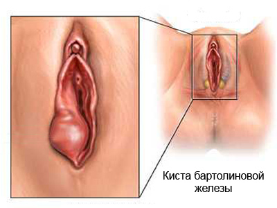 Виды рака половых губ