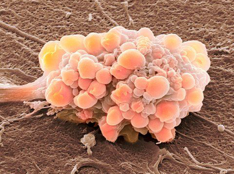 Что такое папиллярный рак (карцинома) мочевого пузыря?