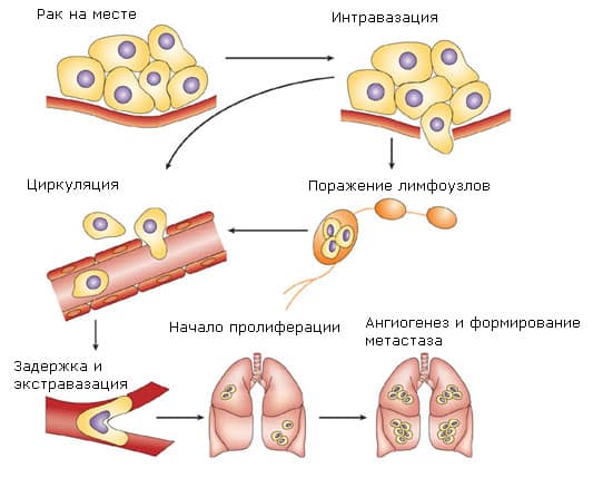  Метастазы: особенности и пути их распространения при раке печени