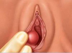 Виды рака половых губ