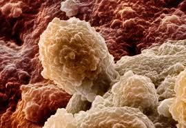 Инвазивный рак мочевого пузыря: особенности онкоопухоли