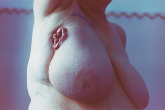 Отличие рака груди от саркомы груди