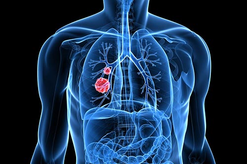 Основные виды плоскоклеточного рака легких