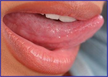 Что такое рак под языком?