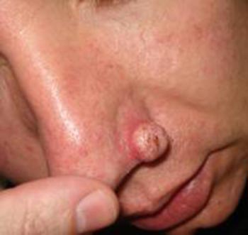 Причины плоскоклеточного рака носа