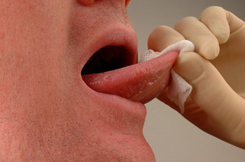 Статистика локализации рака полости рта и языка: