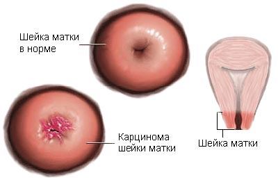 Какие существуют виды плоскоклеточного рака шейки матки?