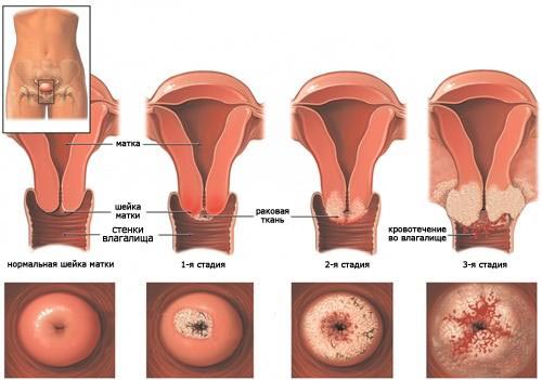 Какие существуют виды плоскоклеточного рака шейки матки?